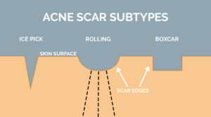 acne scar subtypes (ice pick, rolling, boxcar)