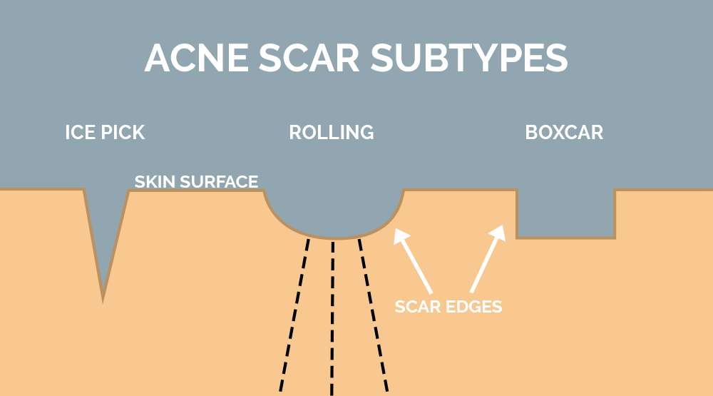 Acne Scarring – Dr. Rabi Dermatology