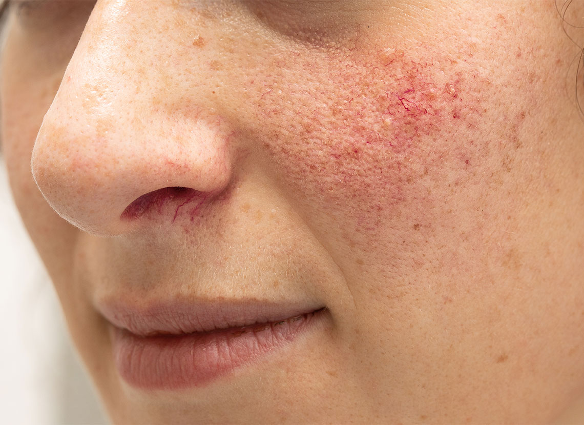 rosacea