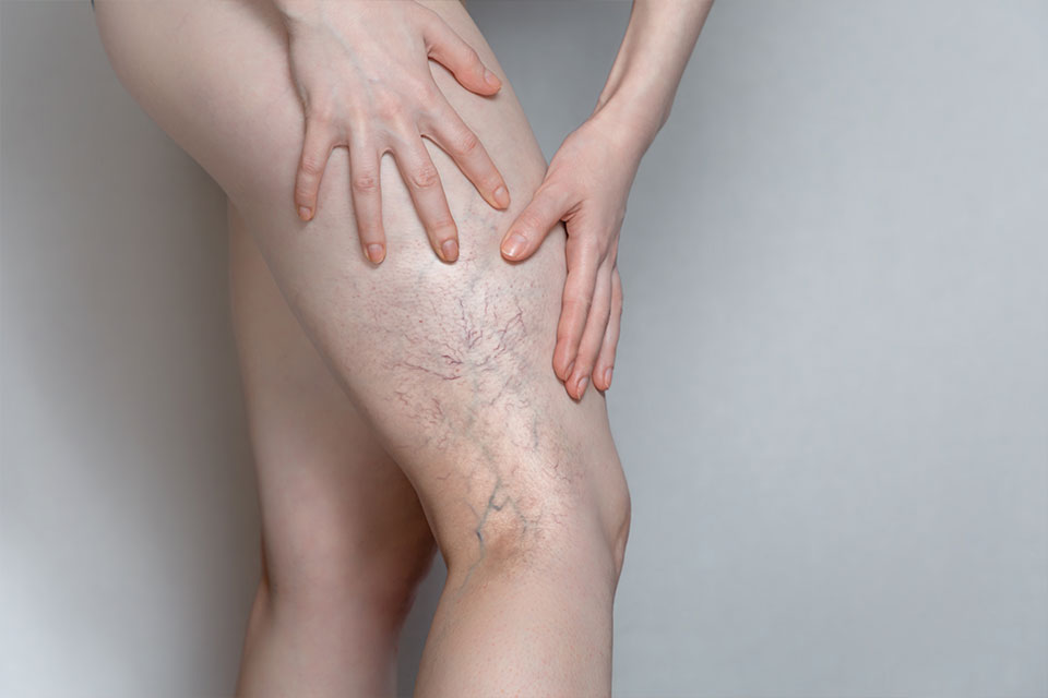 spider veins on side and back of leg