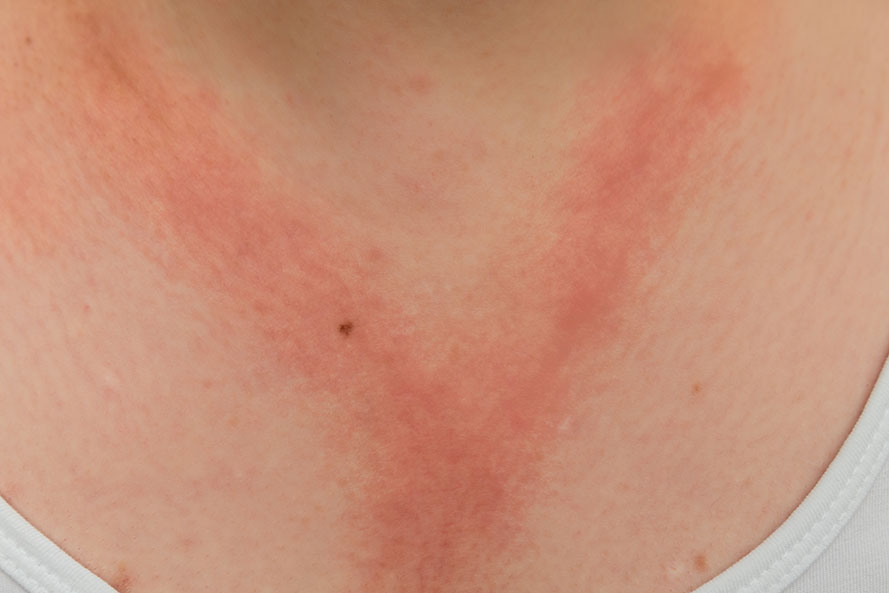 contact dermatitis close-up on chest