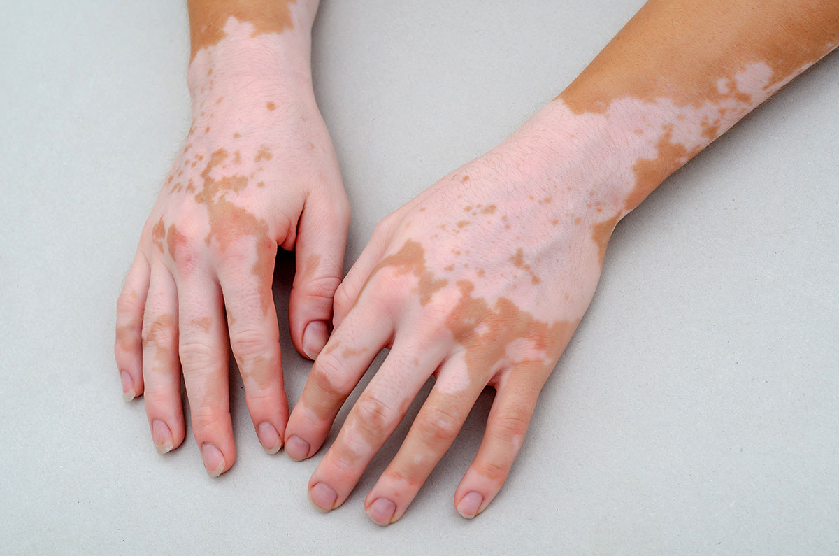 vitiligo on the hands and arms