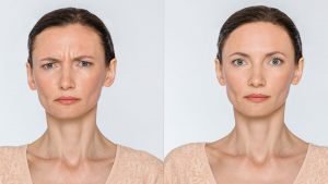 botox before-and-after comparison