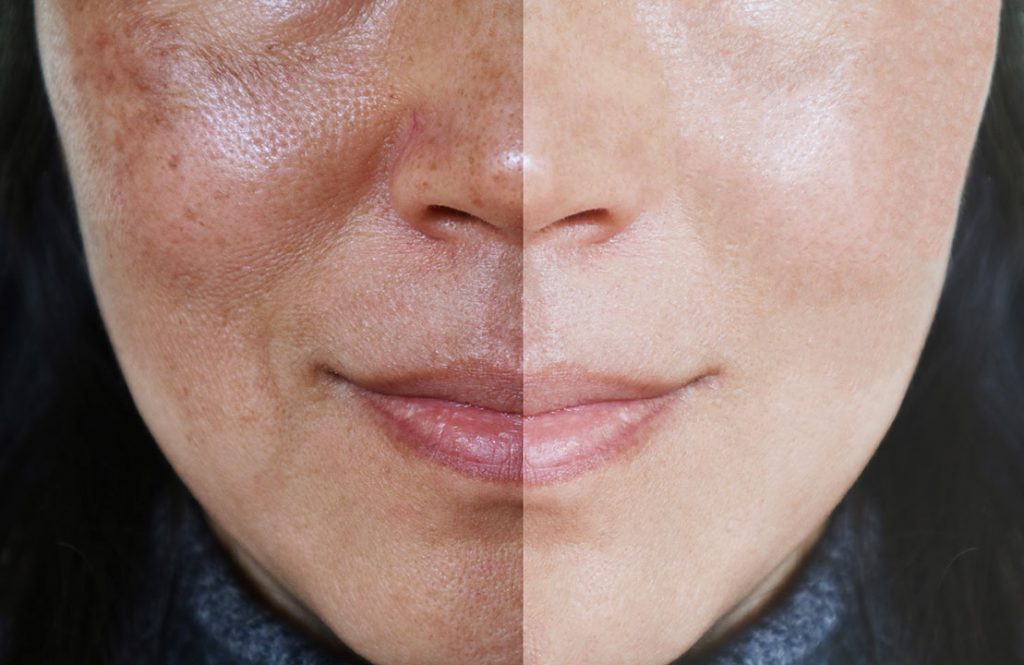 melasma treatment before-and-after comparison