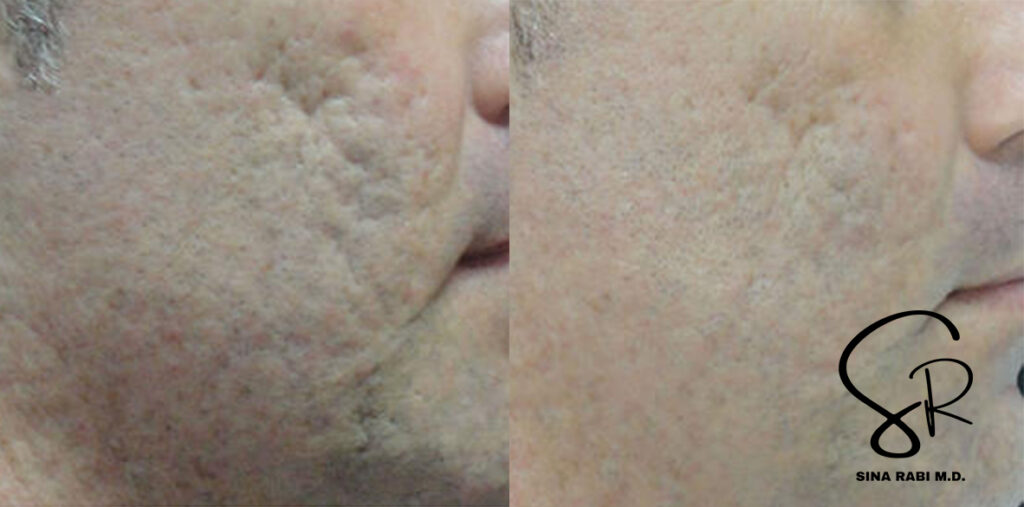 acne scarring treatment before-and-after comparison