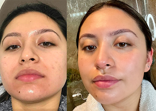 acne scarring treatment before-and-after comparison