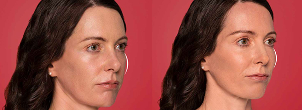 cheek filler before-and-after comparison