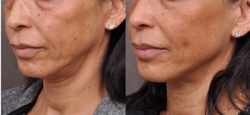 profound skin tightening before-and-after comparison