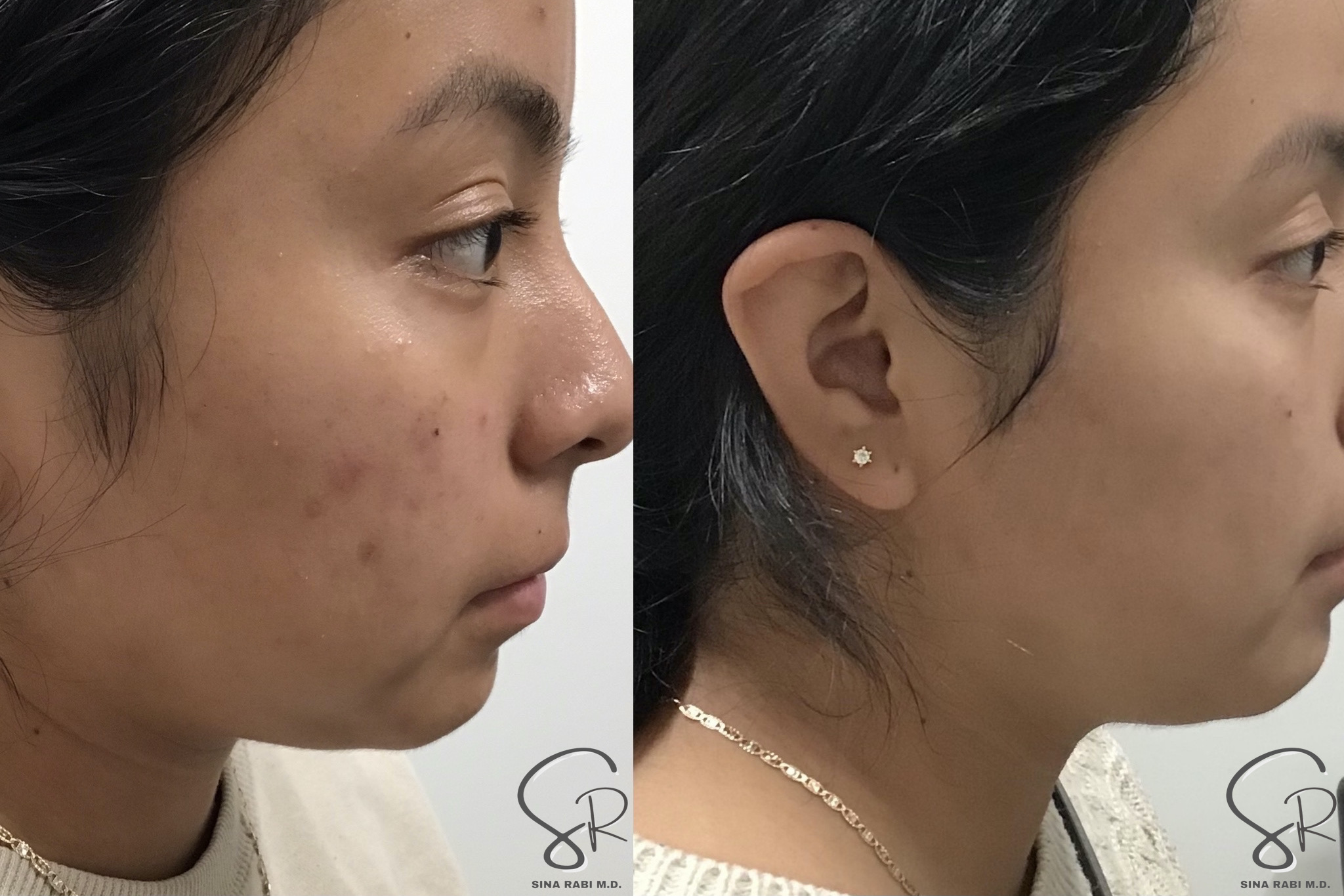 sublative radiofrequency before-and-after comparison