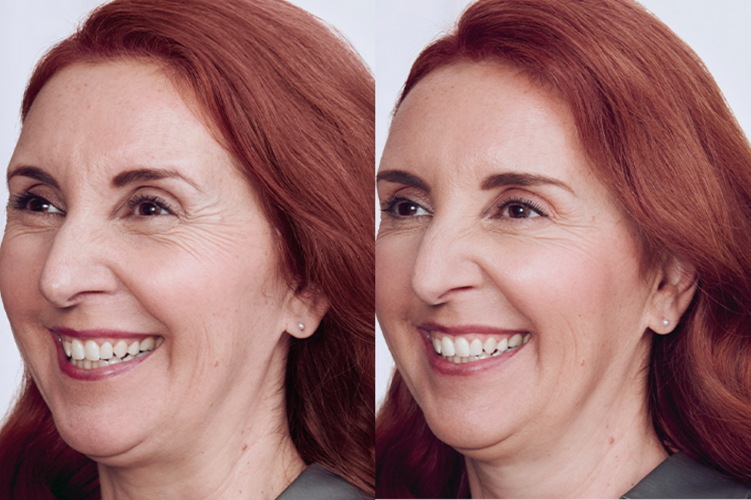 botox before-and-after comparison