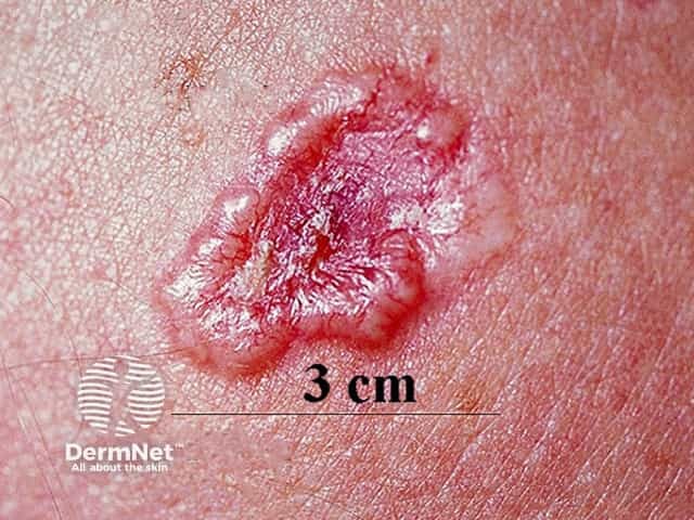 Basal-cell-carcinoma