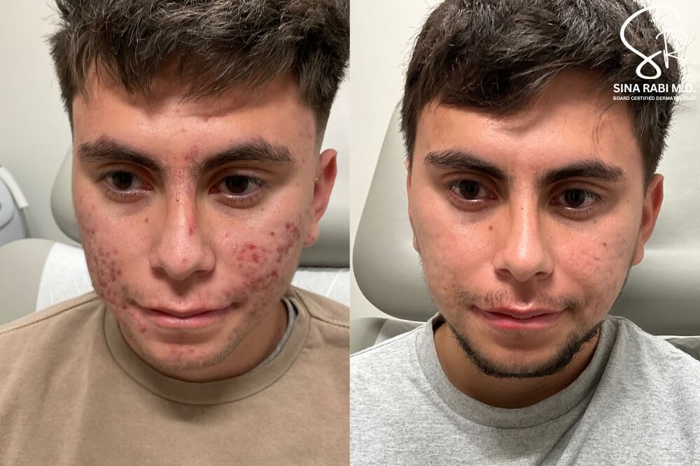 Microneedling & Accutane For Acne