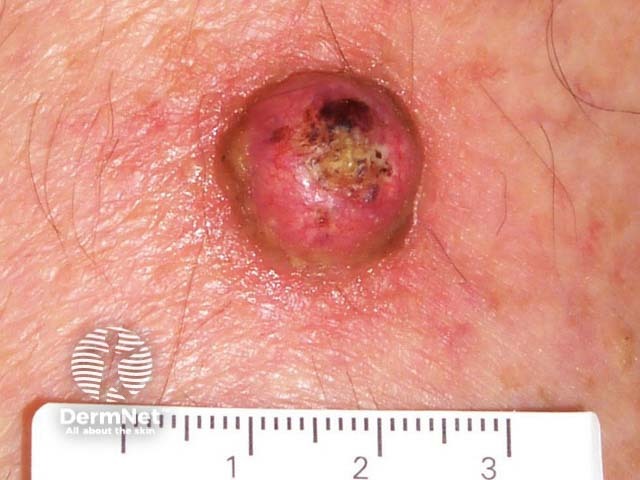 carcinoma