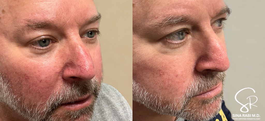 Excel V Vascular Laser